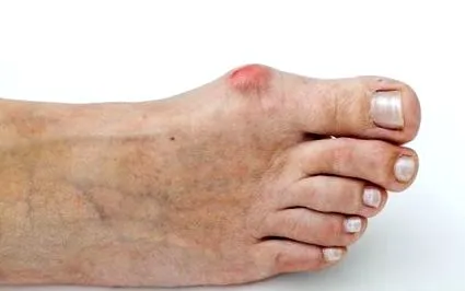 valgus zici