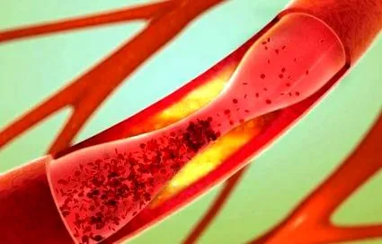 tönkreteszi arteriosclerosis