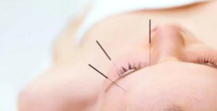 acupunctura durere