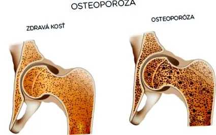 osteoporoza osteoporoza