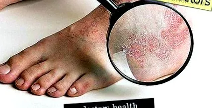 psoriazisul