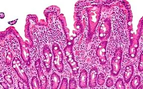 giardia duodenum