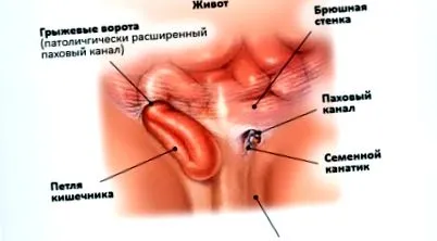 inguinalis rehabilitációs