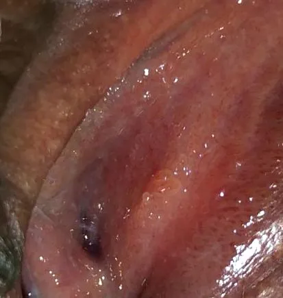 papilloma vírus