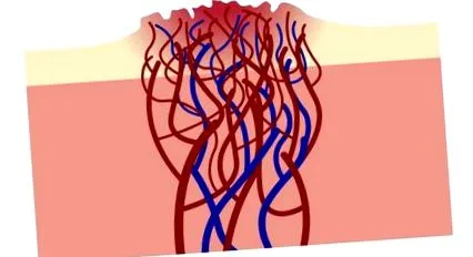 hemangioma fordul