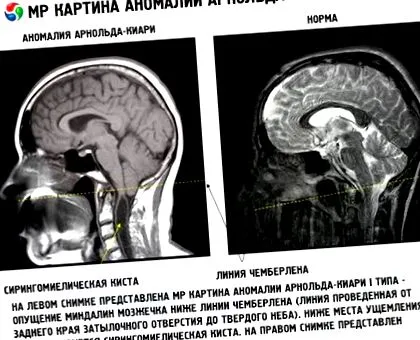 синдром