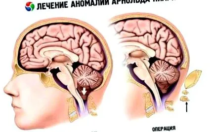 синдром