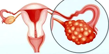 szindróma pcos