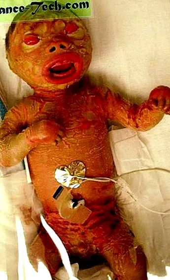 perinatal
