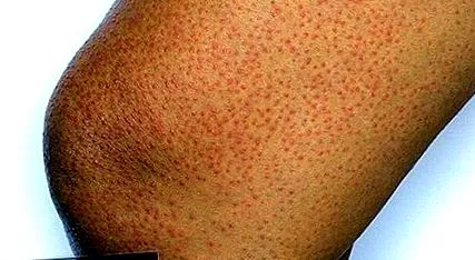 hyperkeratosis hyperkeratosis