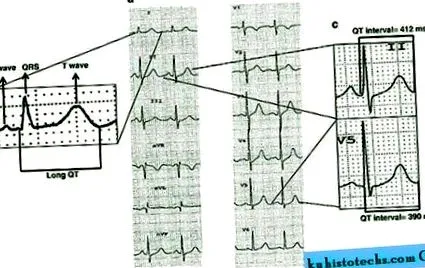 ventriculare