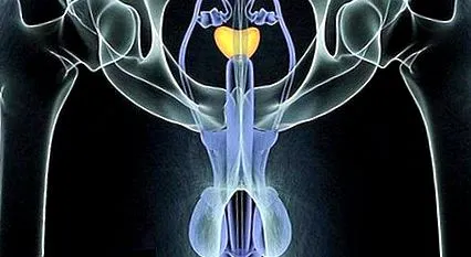 cancerul prostatectomia