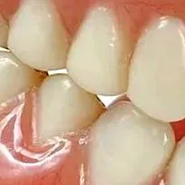 dentare