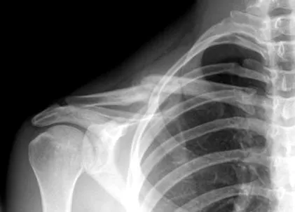 claviculei este