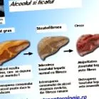 steatóza pečene