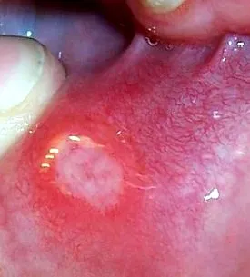 squamous