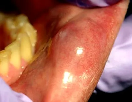 uvula