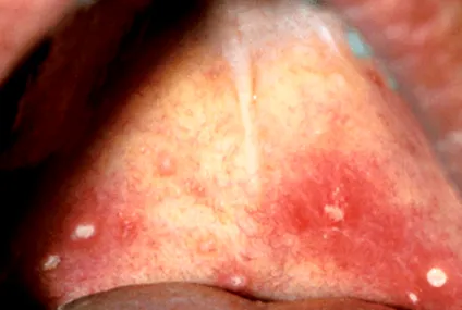 uvula