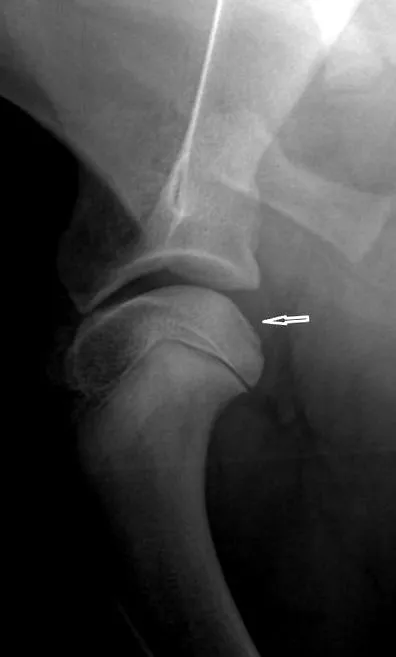 osteocondroza