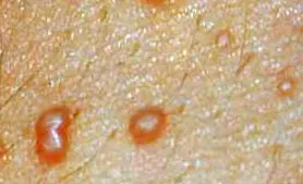 contagioase negii