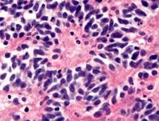 forme neuroblastom