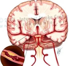 cerebral
