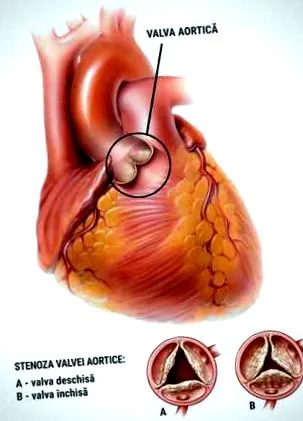 aorta