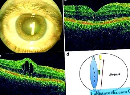 intravitreal implantului