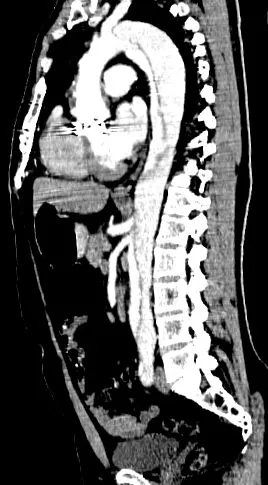 aorta