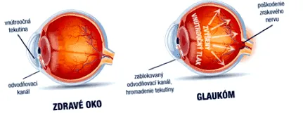 intraoculare măsurarea