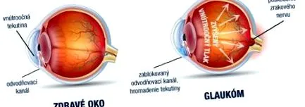 glaucom glaucom