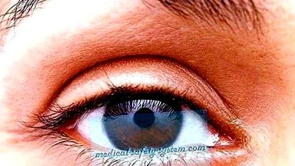 vége presbyopia