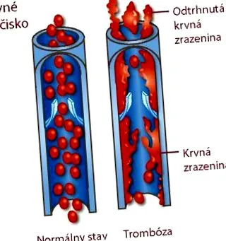 Cauzele cheagurilor