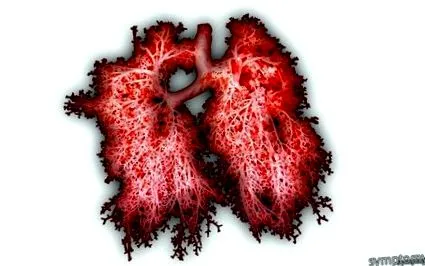 pneumonie