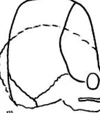 Kleeblattschel anomália craniostenosis