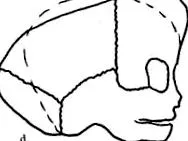 centrokinetic craniostenosis
