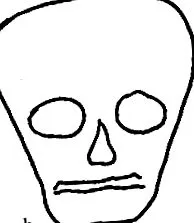 Kleeblattschel anomália craniostenosis
