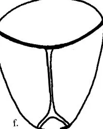 craniostenosis craniostenosis