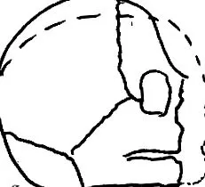 craniostenosis craniostenosis