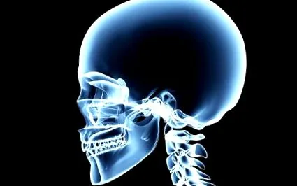 craniostenosis craniostenosis