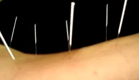 acupunctura
