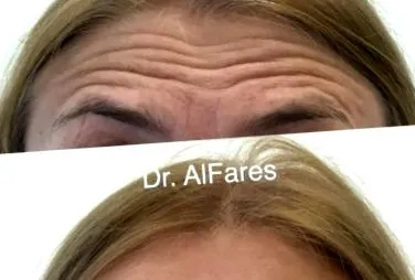 botox