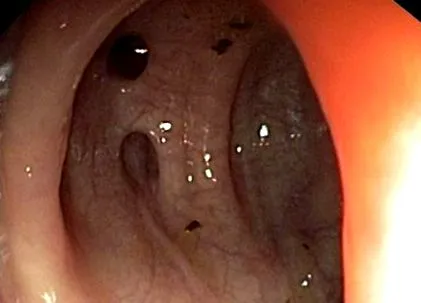 boala intestinului
