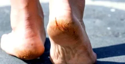 hiperkeratoza cutanată