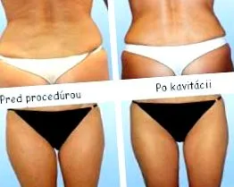 prin liposucție