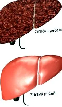 цироза