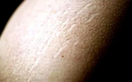 стриите