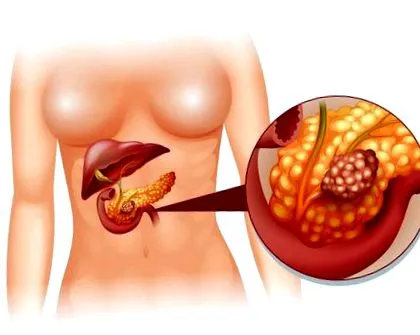 dieta cancerul