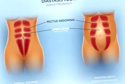 ahovac peretelui abdominal