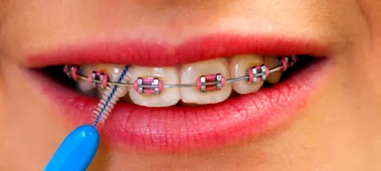 interdentare interdentare